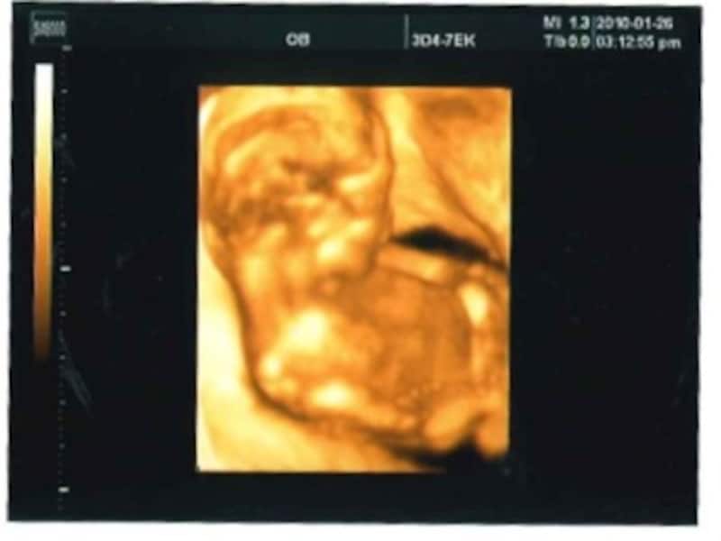 妊娠17週（妊娠5ヶ月,五ヶ月,5カ月）エコー写真・超音波写真