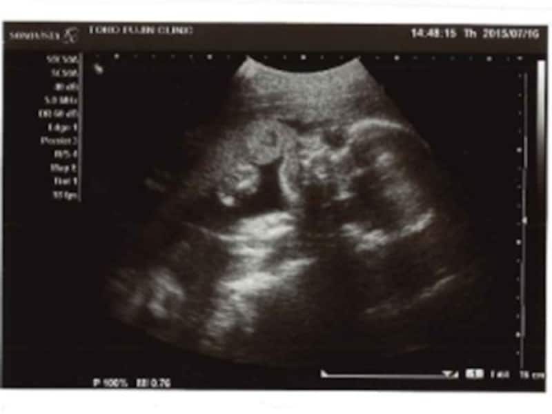 妊娠26週（妊娠7ヶ月,七ヶ月,7カ月）エコー写真・超音波写真