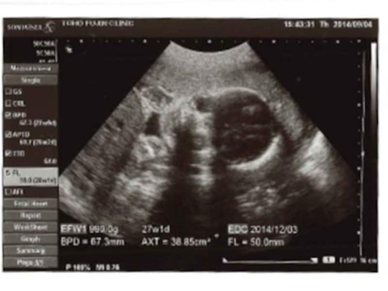 妊娠27週（妊娠7ヶ月,七ヶ月,7カ月）エコー写真・超音波写真