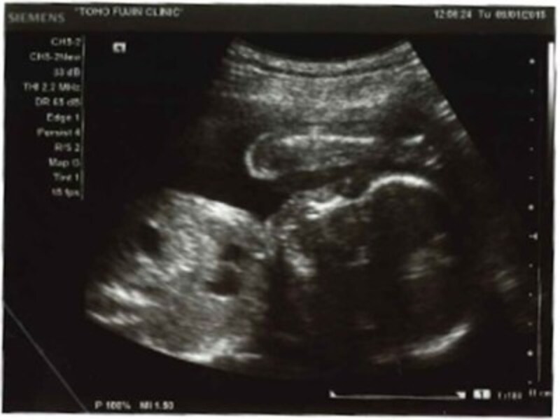 妊娠32週（妊娠9ヶ月・九ヶ月・9か月）エコー写真・超音波写真