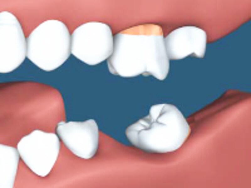 歯並びの変化