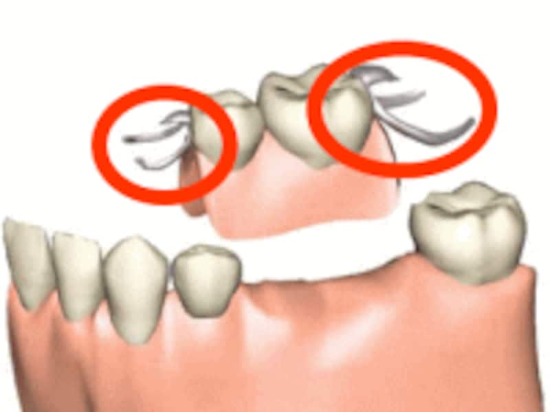 部分入れ歯の構造