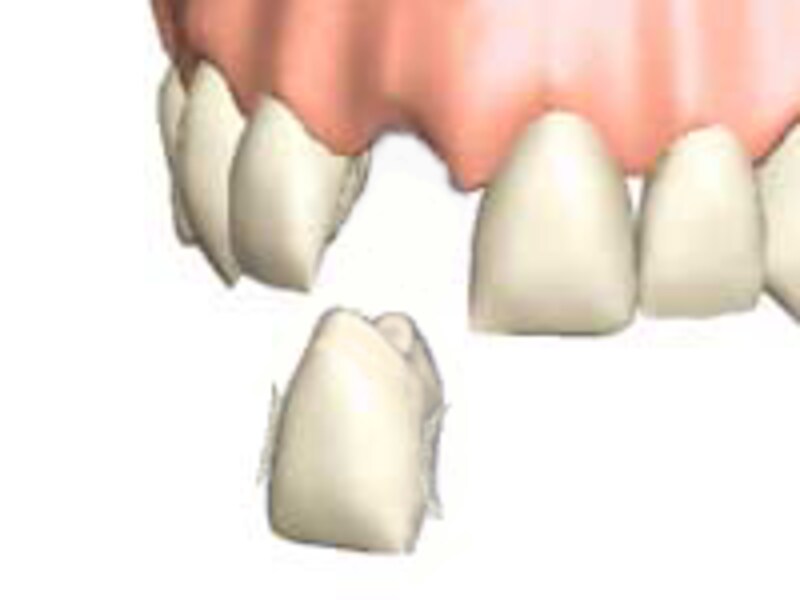 接着性ブリッジ