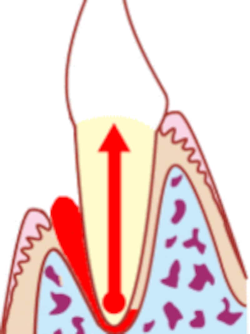 上行性歯髄炎のケース