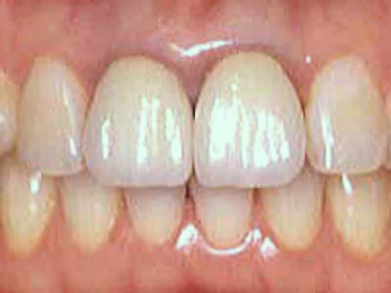 歯の表面