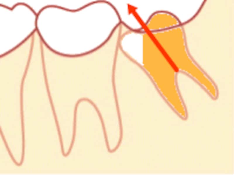 親知らずの抜き方（抜歯）