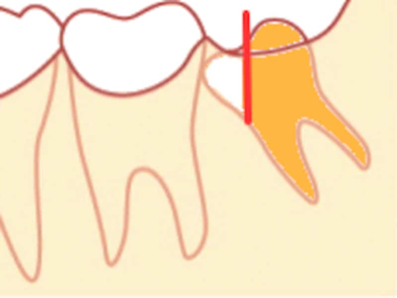 親知らずの抜き方（歯冠切断）
