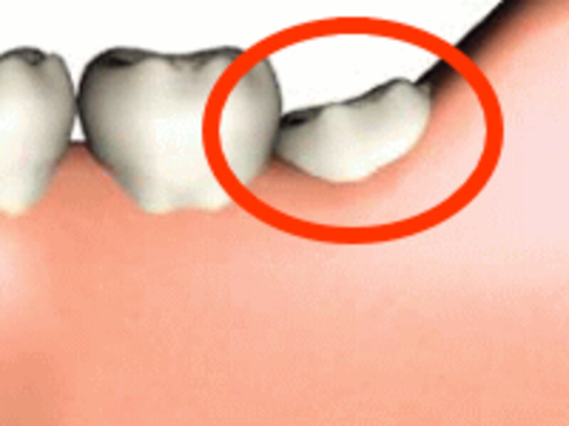 「親知らず」抜くと腫れる？腫れない？ [歯・口の病気] All About