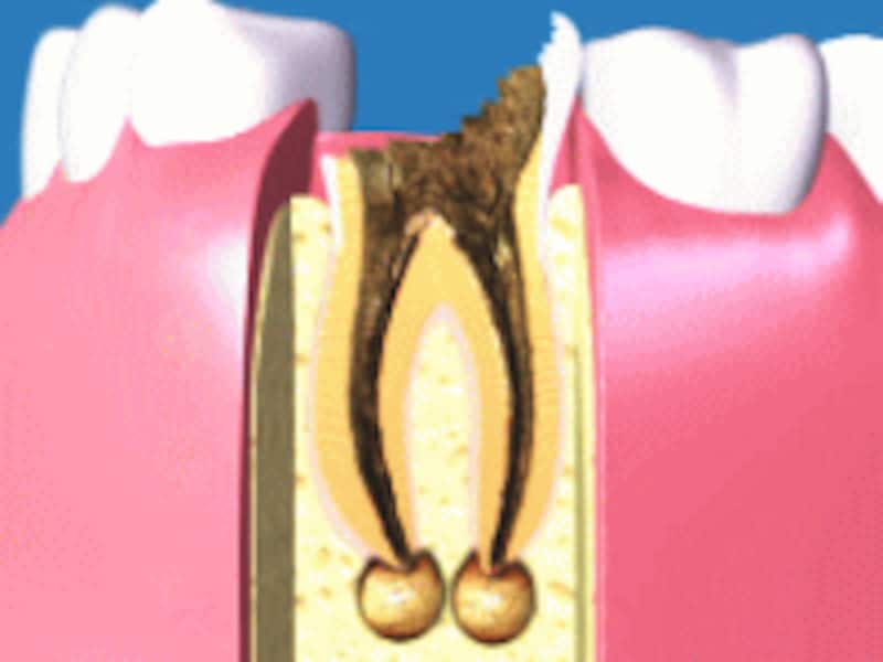 根先性歯周炎