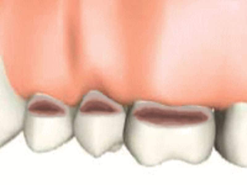 歯 の 根元 削れ 治療