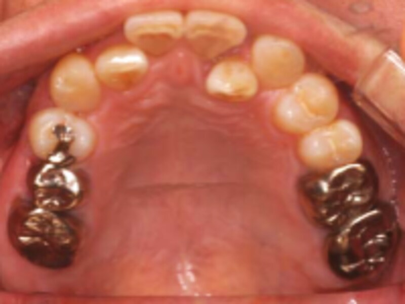 奥歯の被せ物