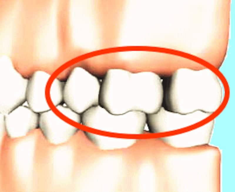 上顎洞に近い歯