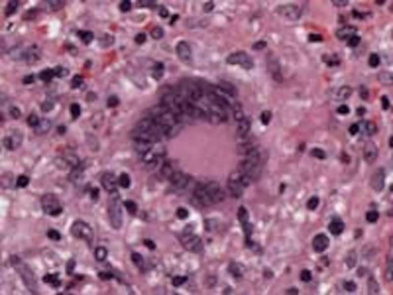 granulation_tissue_1.jpg"