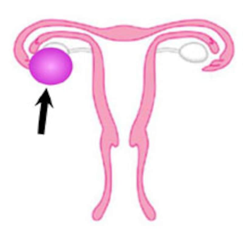 卵巣嚢腫はこんなイメージ！