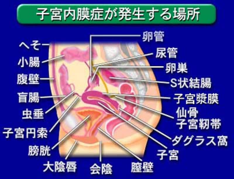 子宮内膜症と不妊症 不妊症 All About 子宮内膜症と不妊症 不妊症 All About