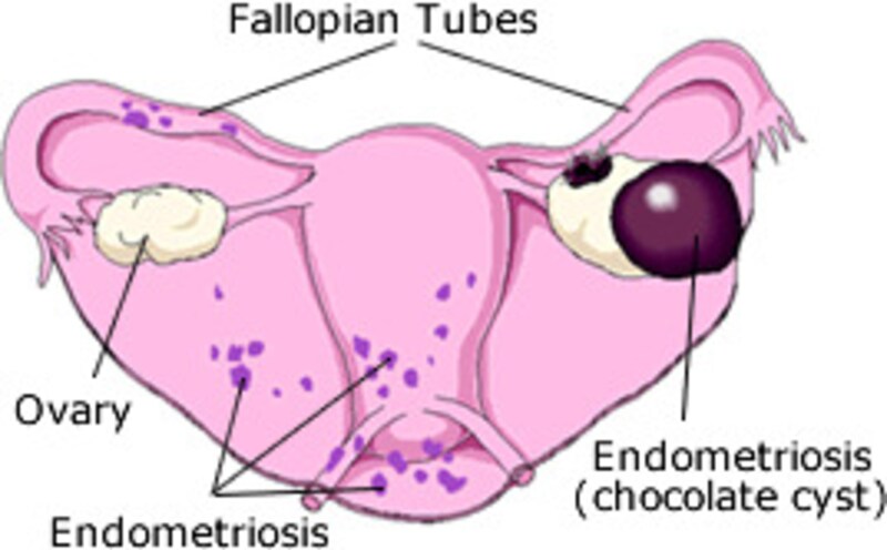 チョコレート嚢胞の原因は何ですか?
