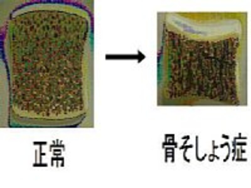 骨粗鬆症ってそもそも何？