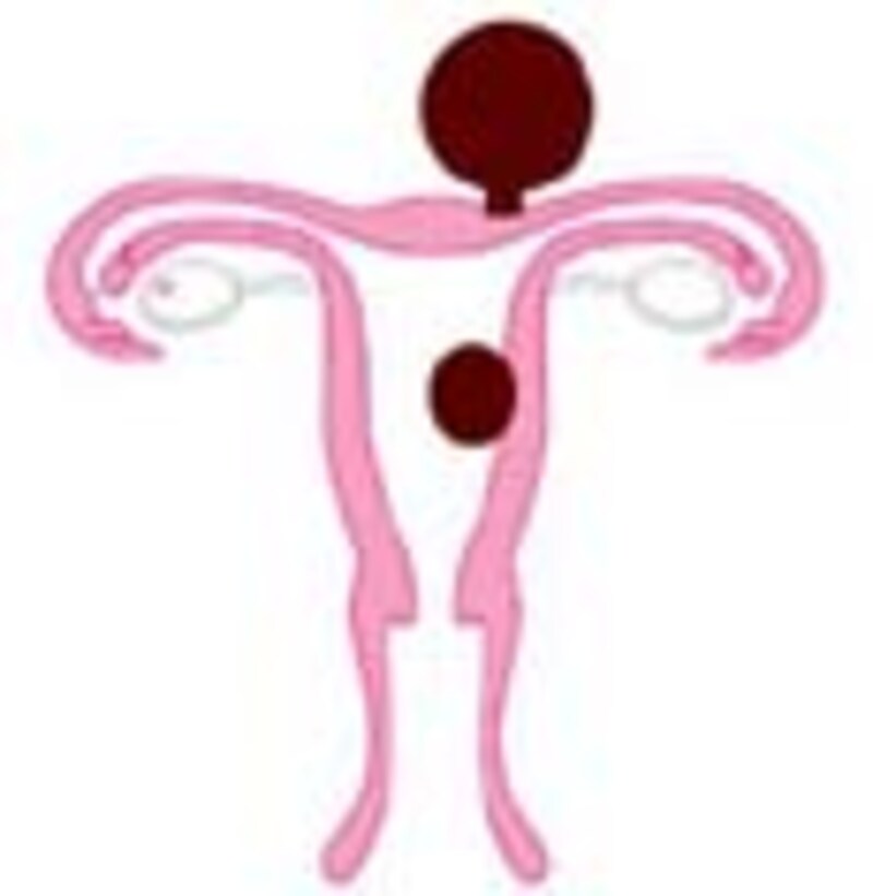 子宮筋腫はこんなイメージ！子宮にできる”コブ”です