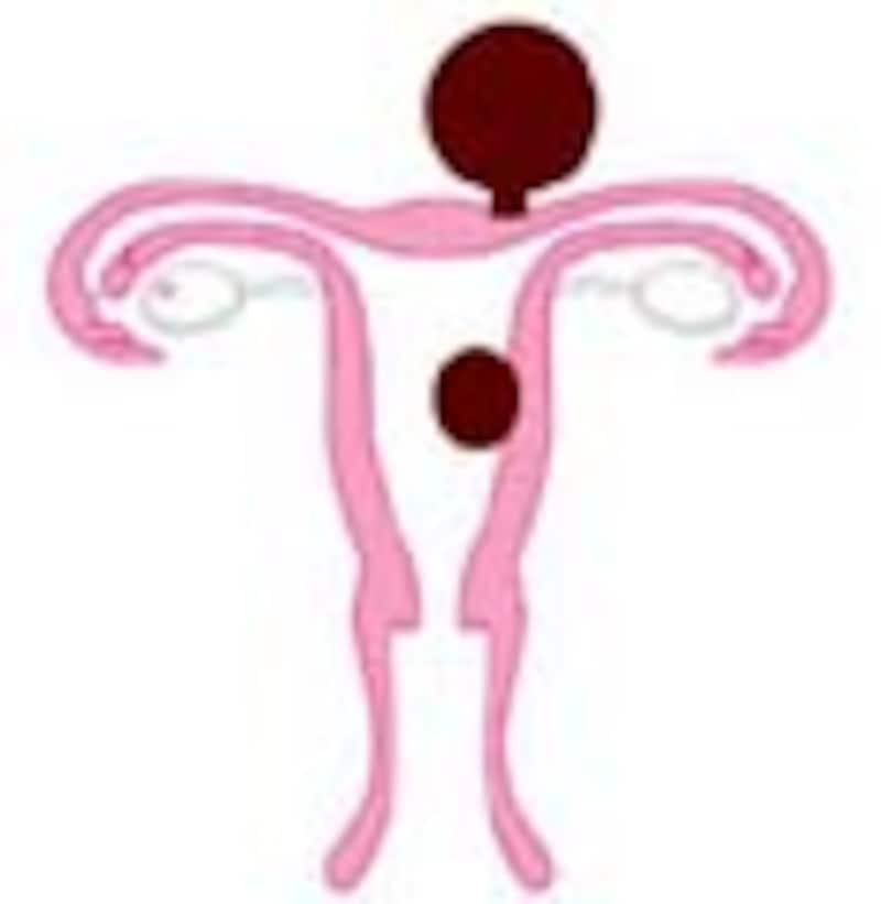 子宮筋腫は子宮にできる&rdquo;コブ&rdquo;です