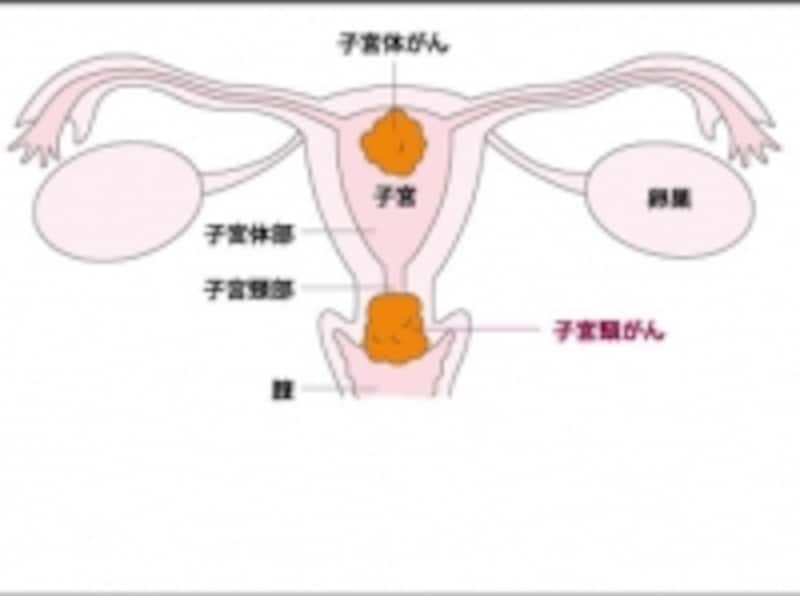 子宮に発生するがんは2つあります。特に子宮頸がんは若い女性に多い