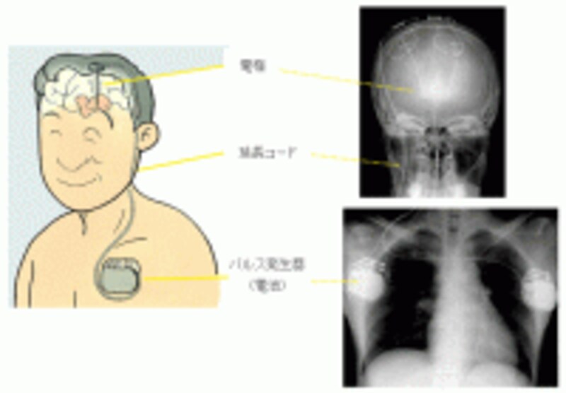 このような手術治療を行うと、パーキンソン病の症状が軽減します。（出典：http://ds.cc.yamaguchi-u.ac.jp/~neuro-w1/clinical_cases/function/parkinson_qa.html）