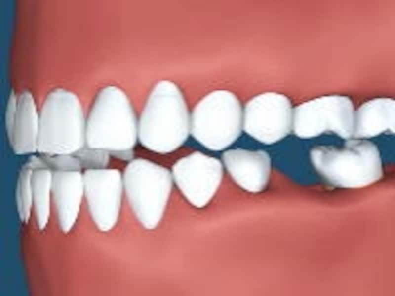臨床では歯を僅かに削るだけで歯の寿命が延びることもしばしば
