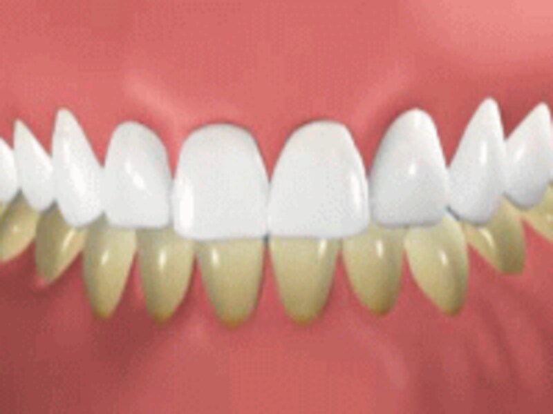 白い歯