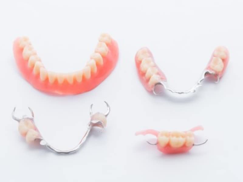 入れ歯の種類と費用の目安 部分入れ歯・総入れ歯