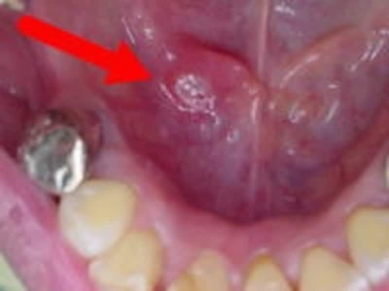 画像 症例写真あり 口内炎セルフチェックのポイント 治療法 歯 口の病気 All About