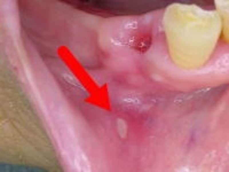画像 症例写真あり 口内炎セルフチェックのポイント 治療法 歯 口の病気 All About