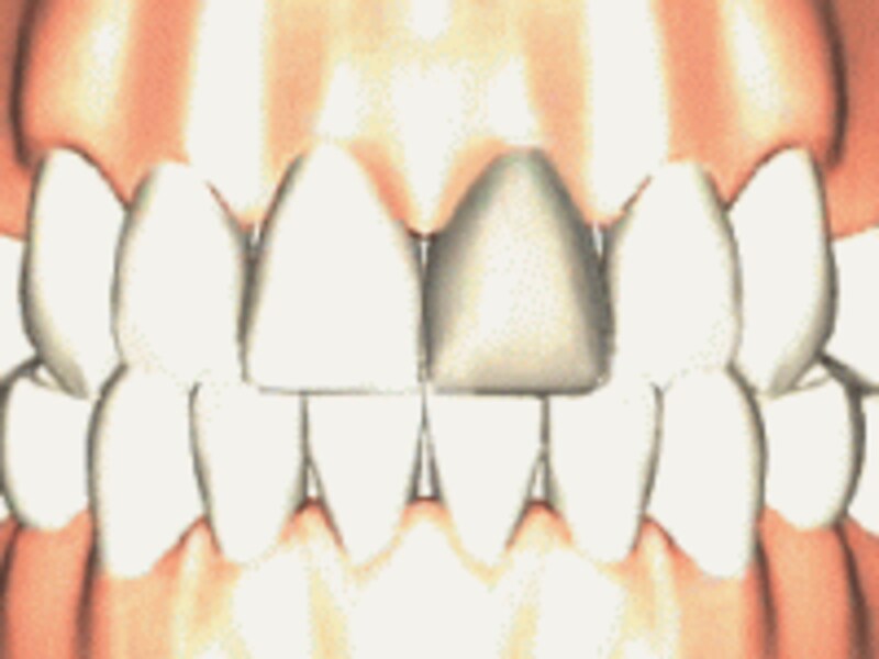 神経を取った歯は、時間が経つと黒ずんでくるくる。特に前歯は１本だけ目立ってしまうことが多い