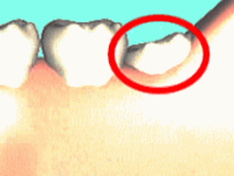 下あごの親知らずはこのような状態で生えていることが多い（赤丸印）、歯肉に隠れてまったく見えないことも…