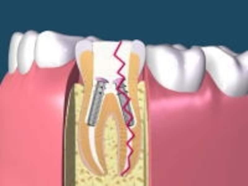 歯根破折（しこんはせつ）とはu2026膿などの症状・治療法 [歯・口の病気 