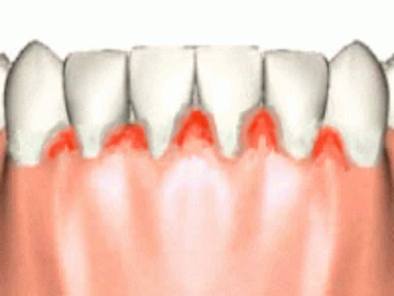 歯肉炎はブラッシング不足の小学生でもよく見られる