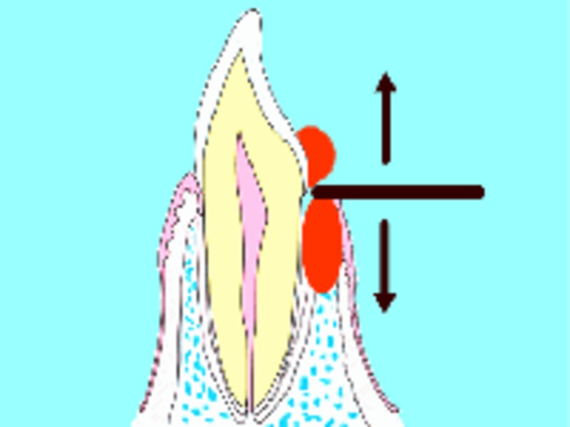 歯石のつく場所