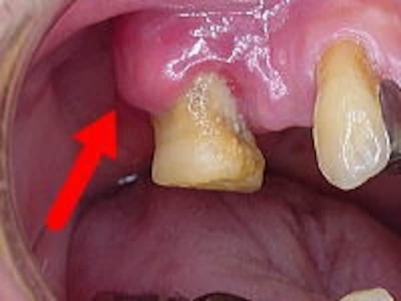 ブヨブヨした腫れと歯の周囲にたくさんのプラークが見られる