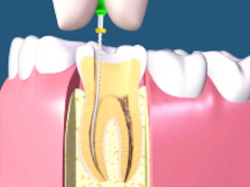 歯 の 神経 を 抜く 痛い