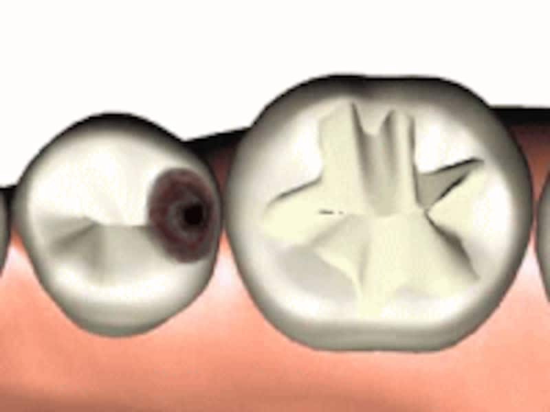 トンネル虫歯２