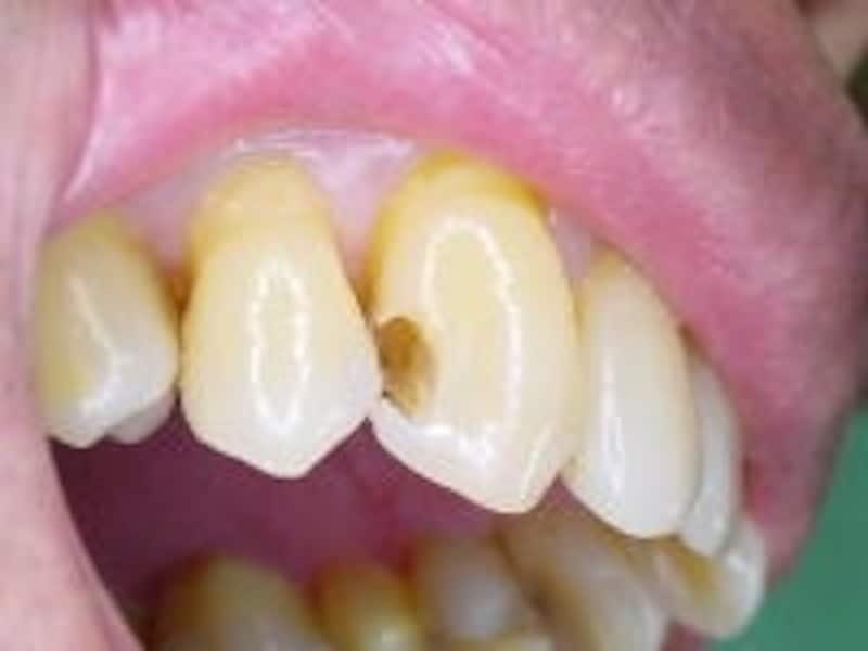 虫歯の部分を取り除くと内部の象牙質まで広がっていたのが分かる