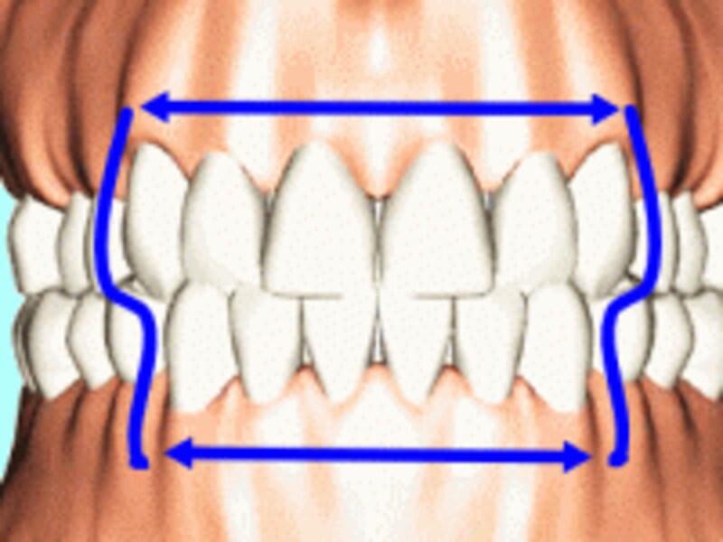 白い歯を被せる場合、保険を利用する一般的ケースでは矢印の範囲内の12本が認められている。これ以外の部分は基本的には金属色の被せものになる