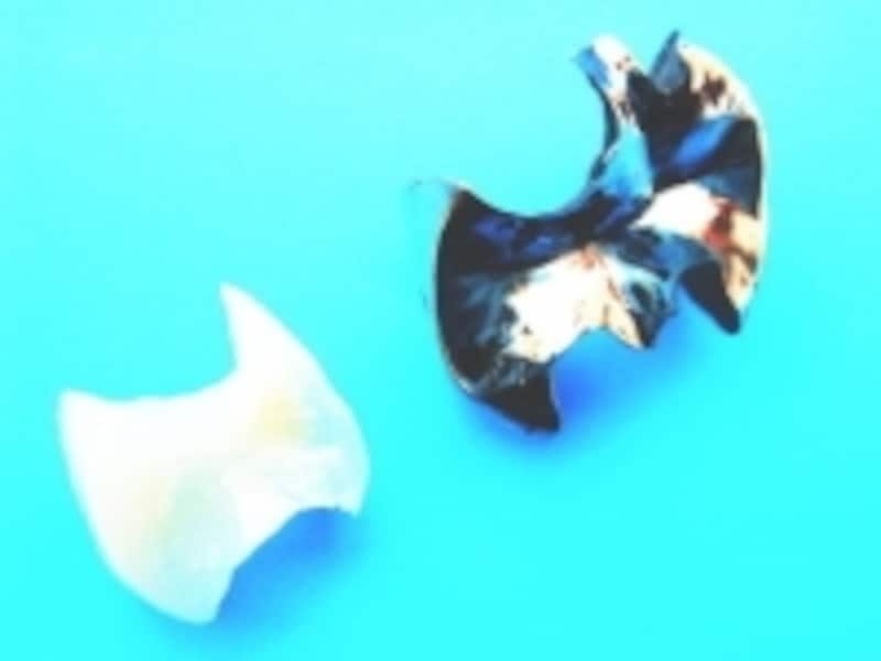 歯に使われている銀歯などの金属は、審美性（見た目）を気にしなければ耐久性はその他のどの材料よりも安定している