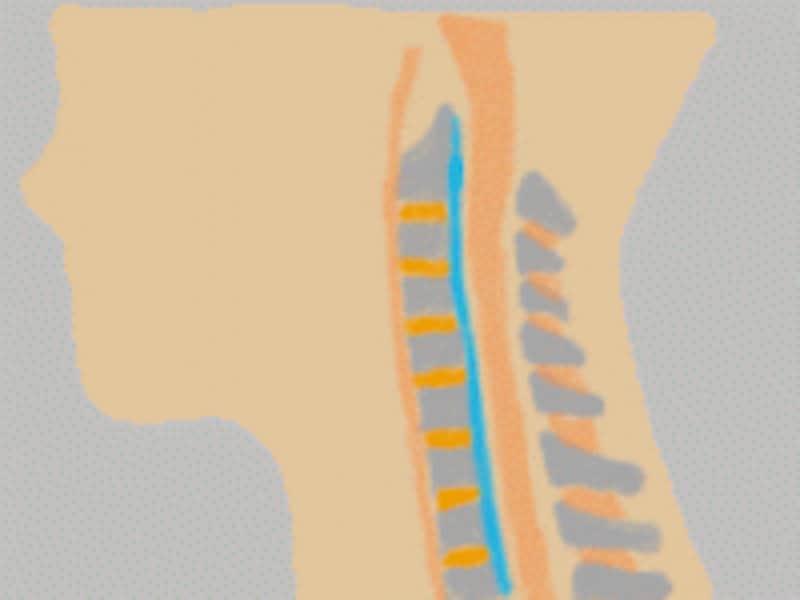 【後縦靭帯骨化症とは】水色部分が後縦靭帯。ここが骨のように硬くなり大きくなると神経根や脊椎を障害する。