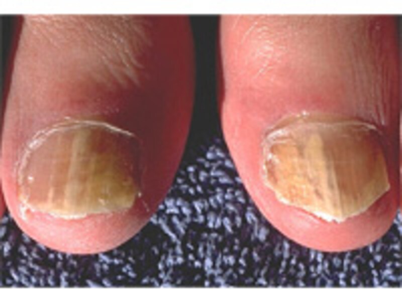 onychomycosis_1.jpg