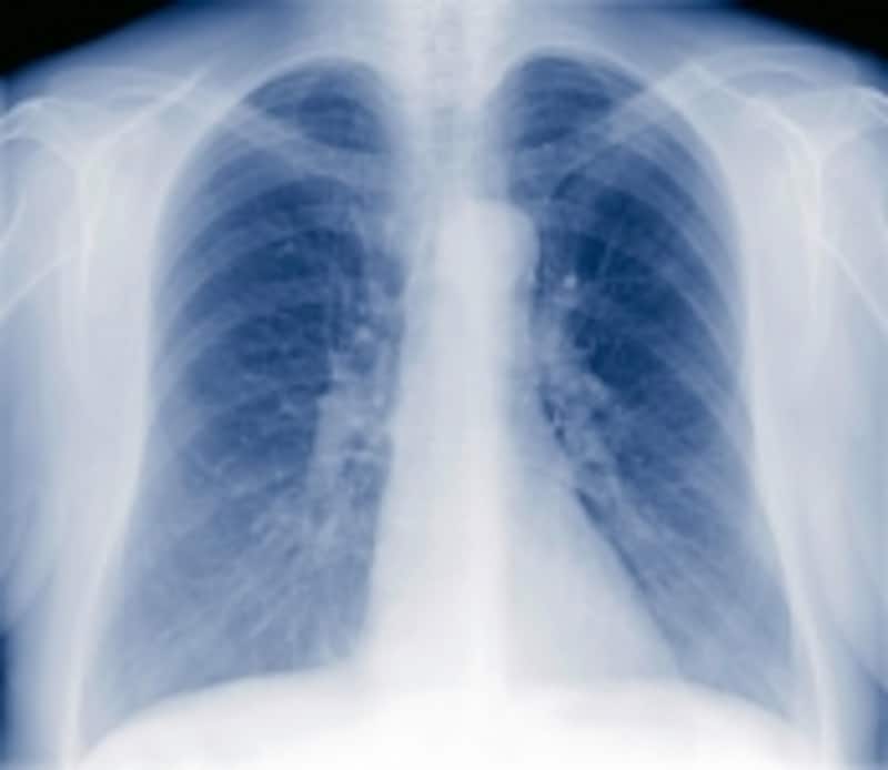 慢性閉塞性肺疾患は、タバコ病とも呼ばれています。