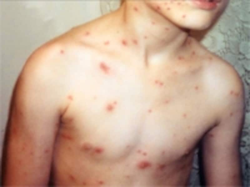 体中に発疹ができる水ぼうそう。成人してからは「帯状疱疹」として再発することがあります