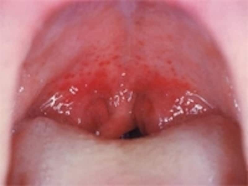 溶連菌感染の始まりは、よくある喉の腫れから