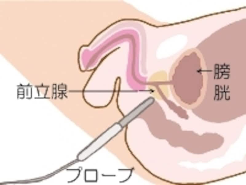 超音波を発する器具を肛門から入れ、前立腺の状態を調べる