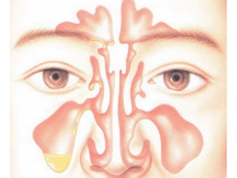 副鼻腔炎の原因・症状・診断・治療