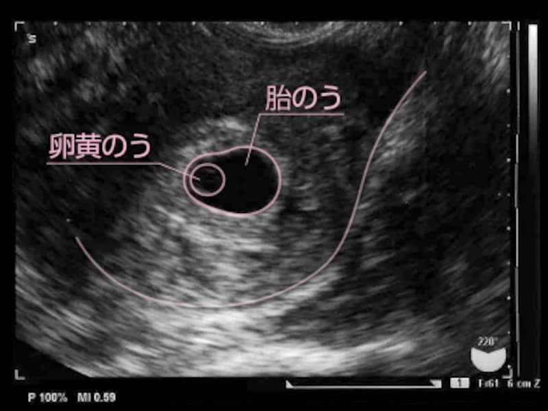 妊娠5週目（5w、妊娠五週目）エコー写真・胎芽・胎嚢・超音波写真