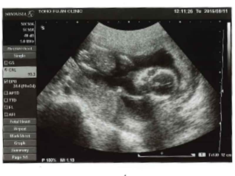 妊娠16週（16w,十六週）の胎児のエコー写真・超音波写真
